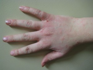 Human_hand_with_dermatitis